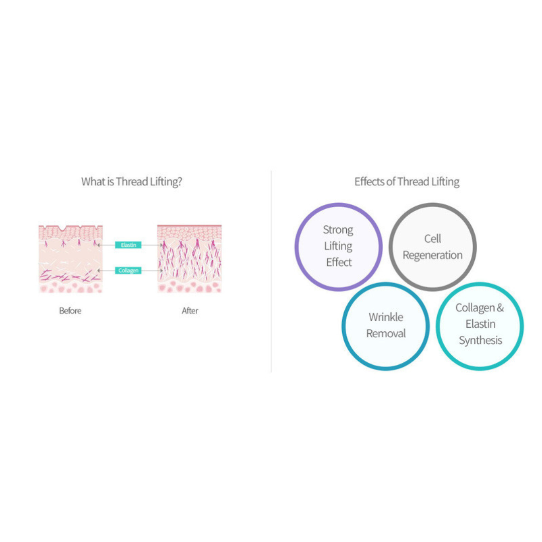 NEOGENESIS PDO TORNADO SCREW 26G, 38MM